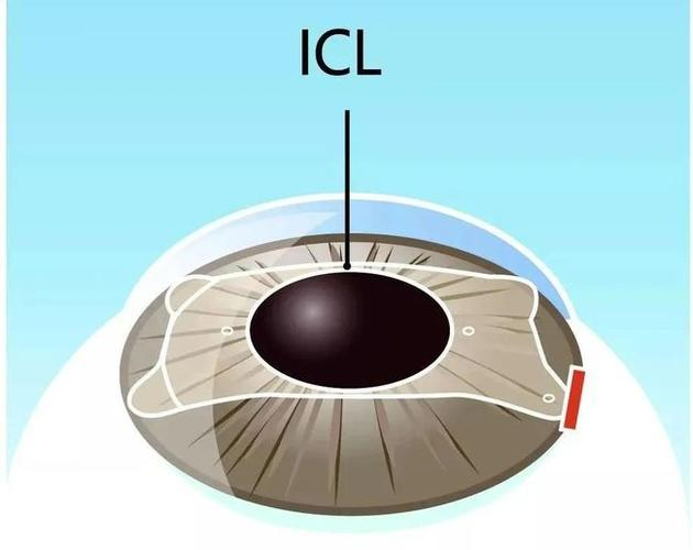 ICL近视手术
